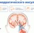 Неделя борьбы с инсультом - Галичский муниципальный район